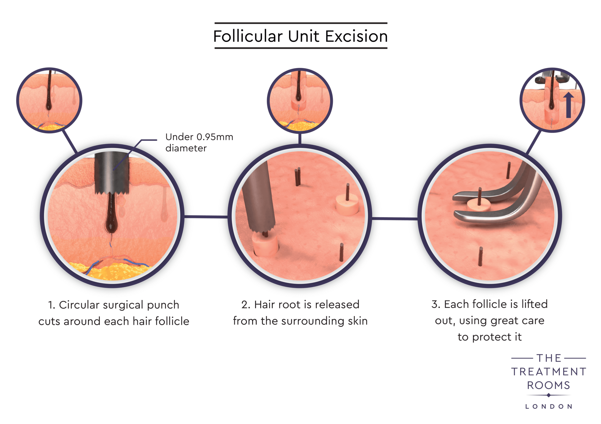 01 TR Extraction v04