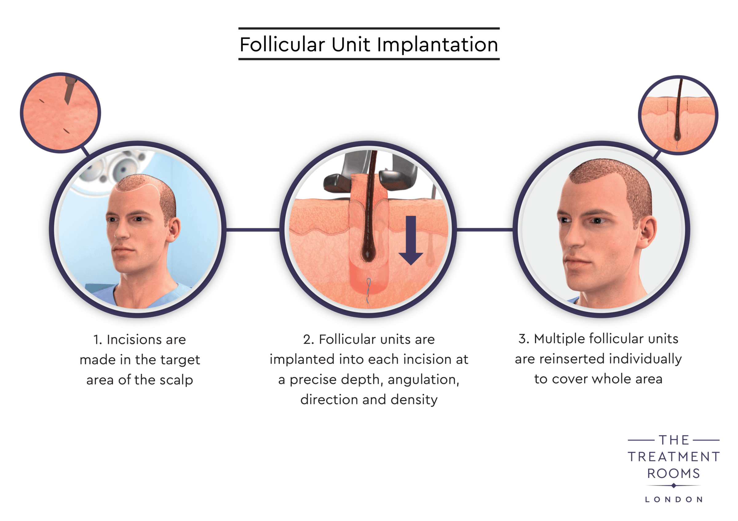 02 TR IMPLANTATION v04